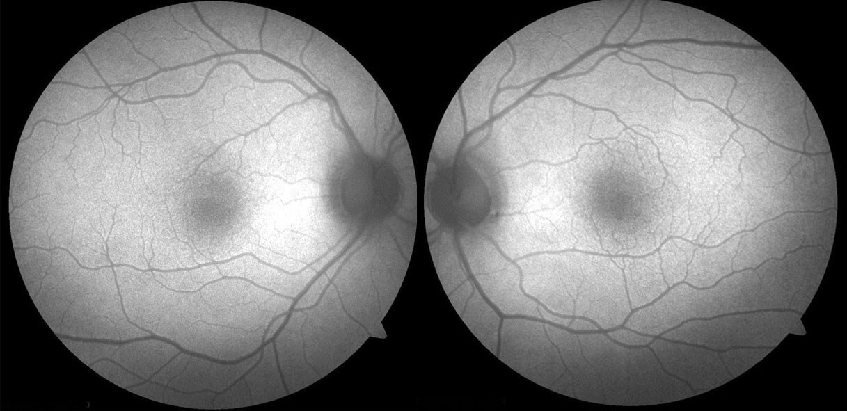 Fundus autofluorescence is normal without hyperautofluorescence as might be seen in adult onset vitelliform foveomacular dystrophy.