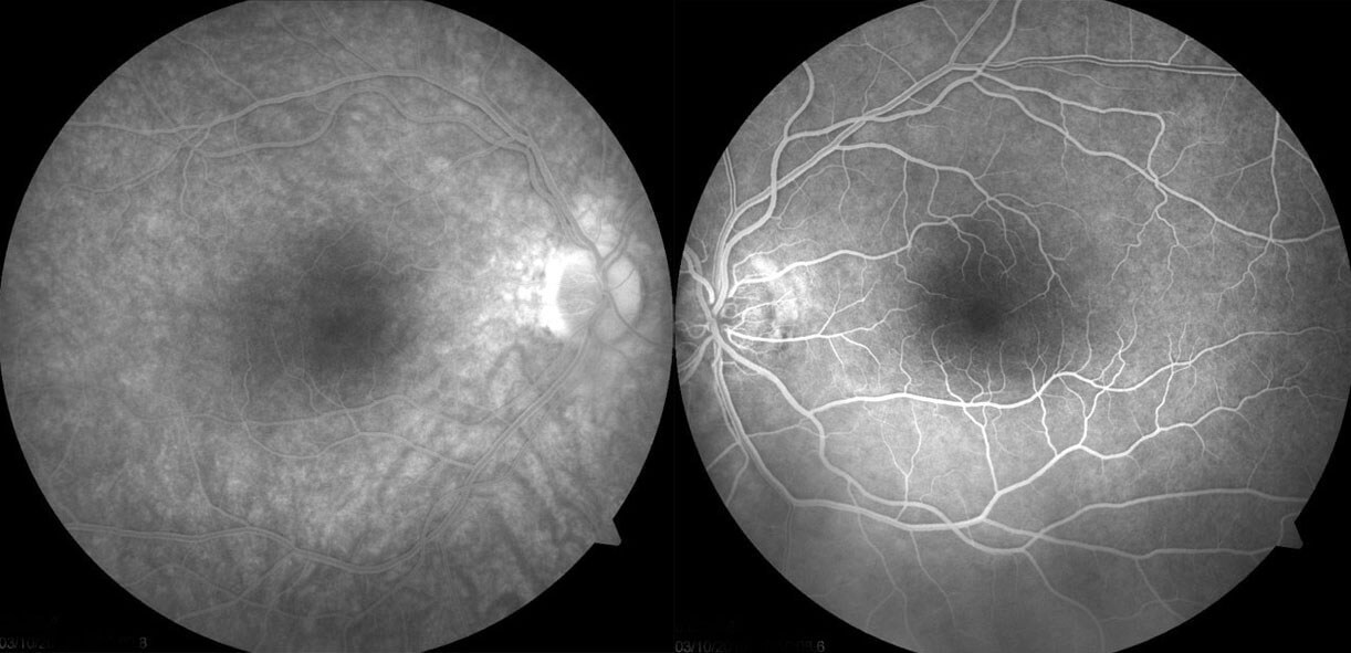 Fluorescein angiography is normal with no angiographic macular oedema.
