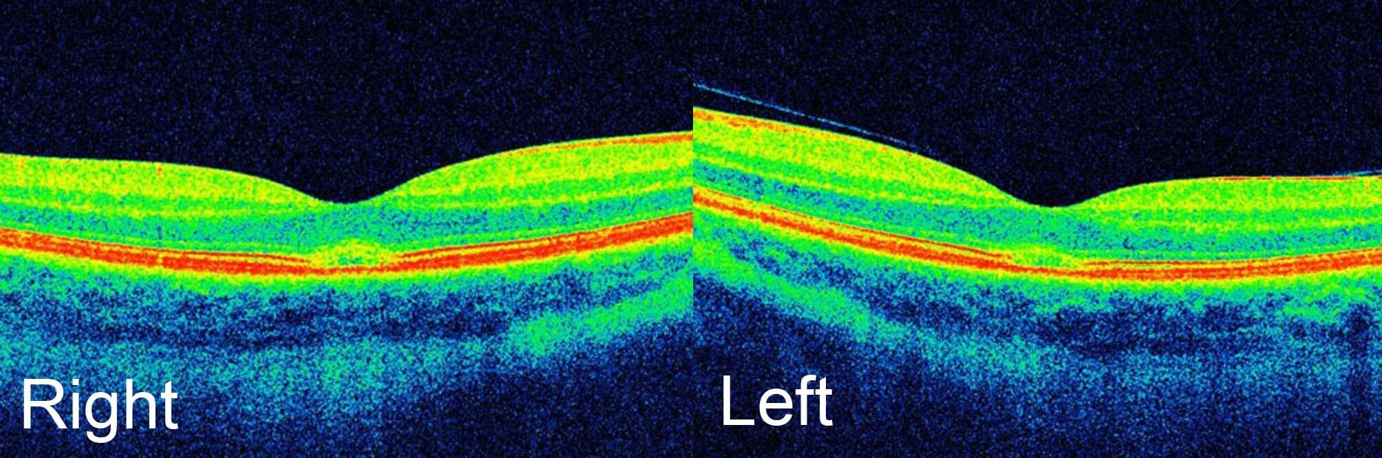 Optical coherence tomography scans six weeks after reduced popper use demonstrating persisting subfoveal disruption of the ellipsoid layer but some flattening of the dome shaped elevation.