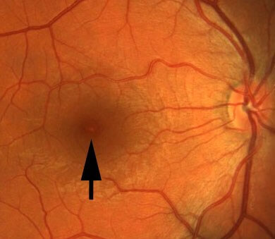 Optical coherence tomography scans six weeks after reduced popper use demonstrating persisting subfoveal disruption of the ellipsoid layer but some flattening of the dome shaped elevation.