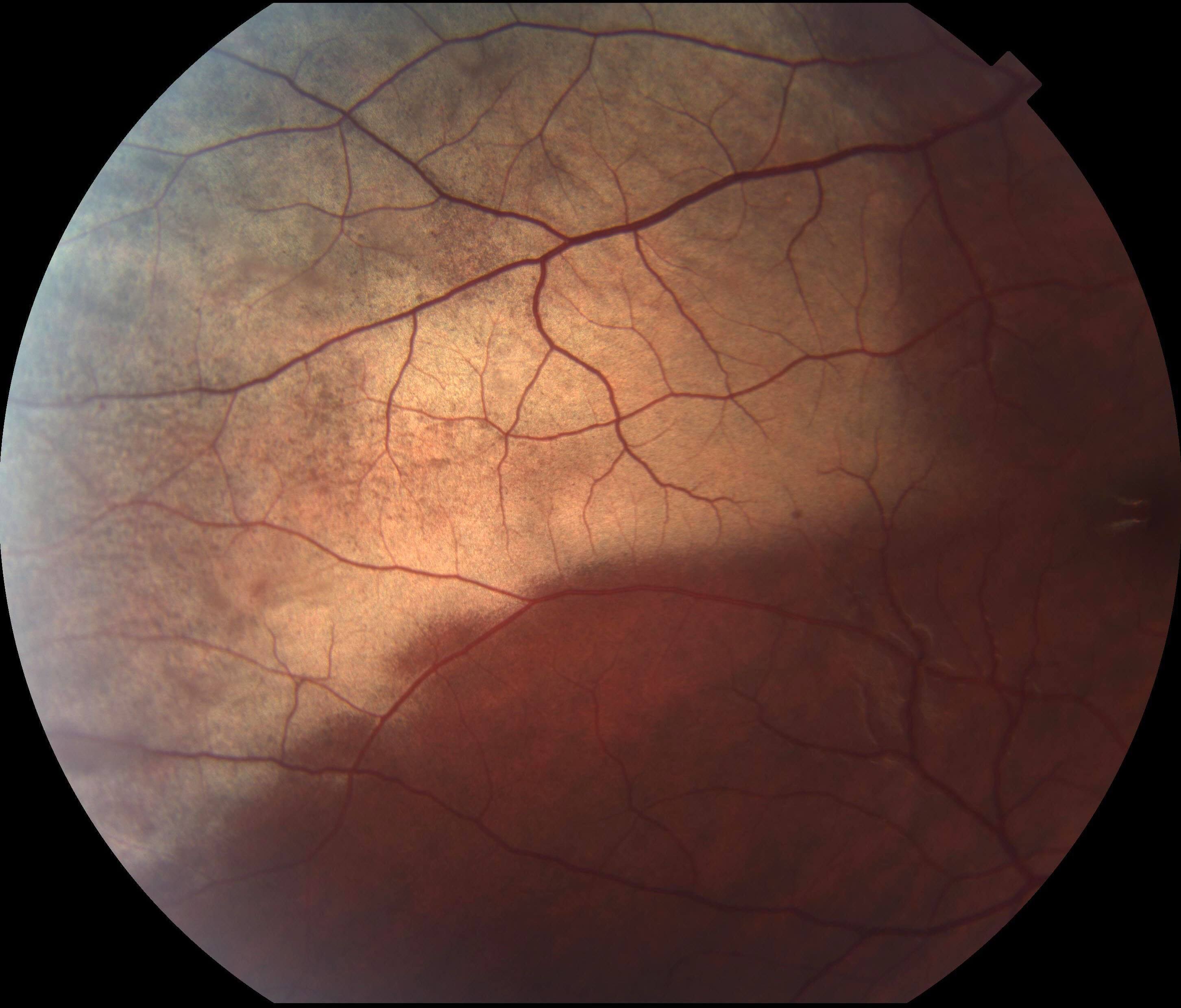 The retinal whitening extends along the superotemporal vascular arcade.