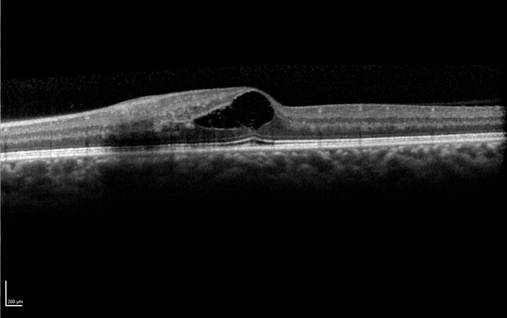 Spectral-domain optical coherence tomography demonstrated cystoid macular oedema. Note the integrity of the foveal photoreceptor layer in particular the ellipsoid zone (IS-OS junction) and external limiting membrane (ELM).