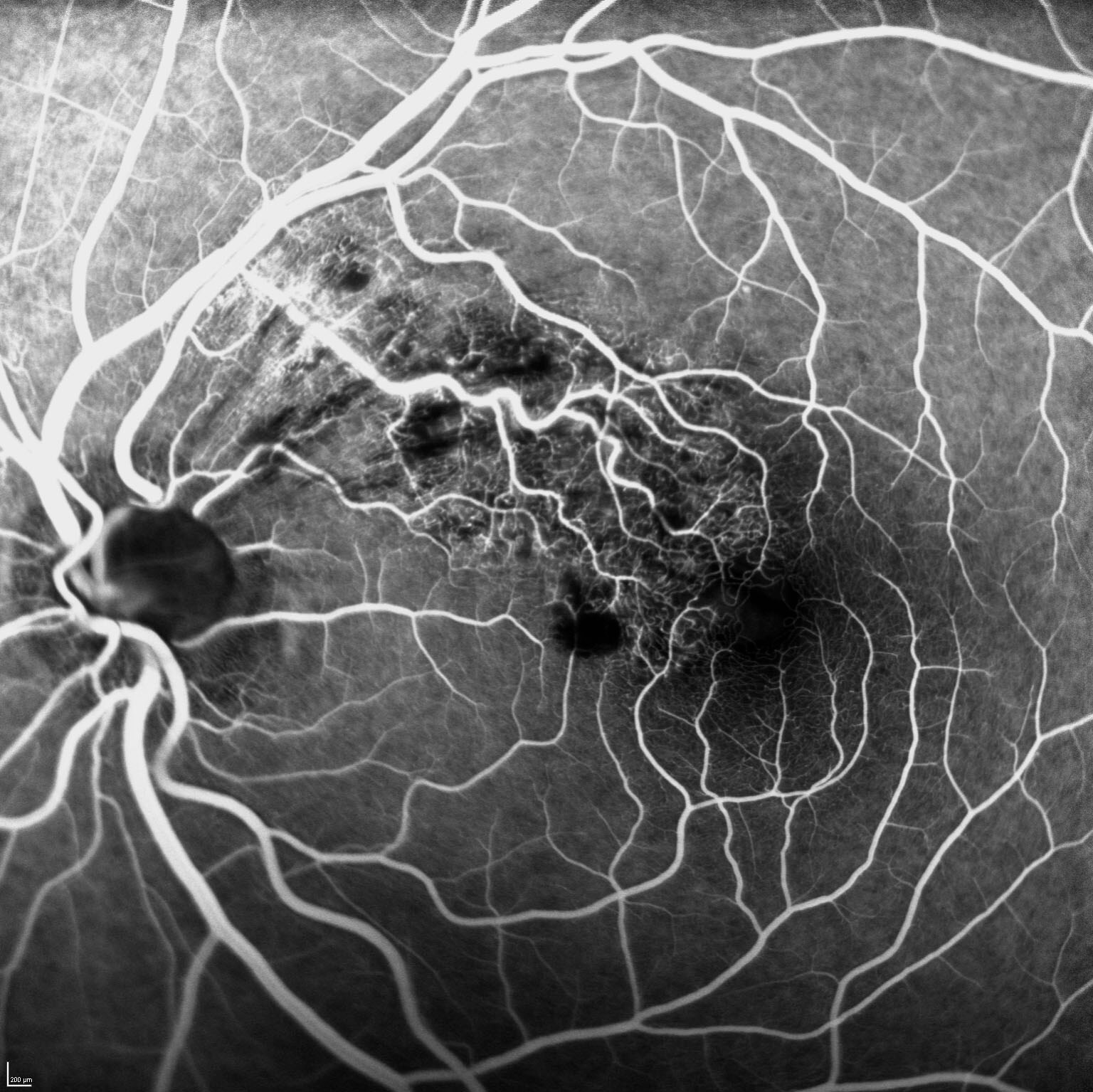 Early-mid phase FFA demonstrates mild dilatation of the occluded macular vein and blocked fluorescence due to haemorrhage. There was subtle widening of the intercapillary spaces superonasal to the foveal avascular zone.