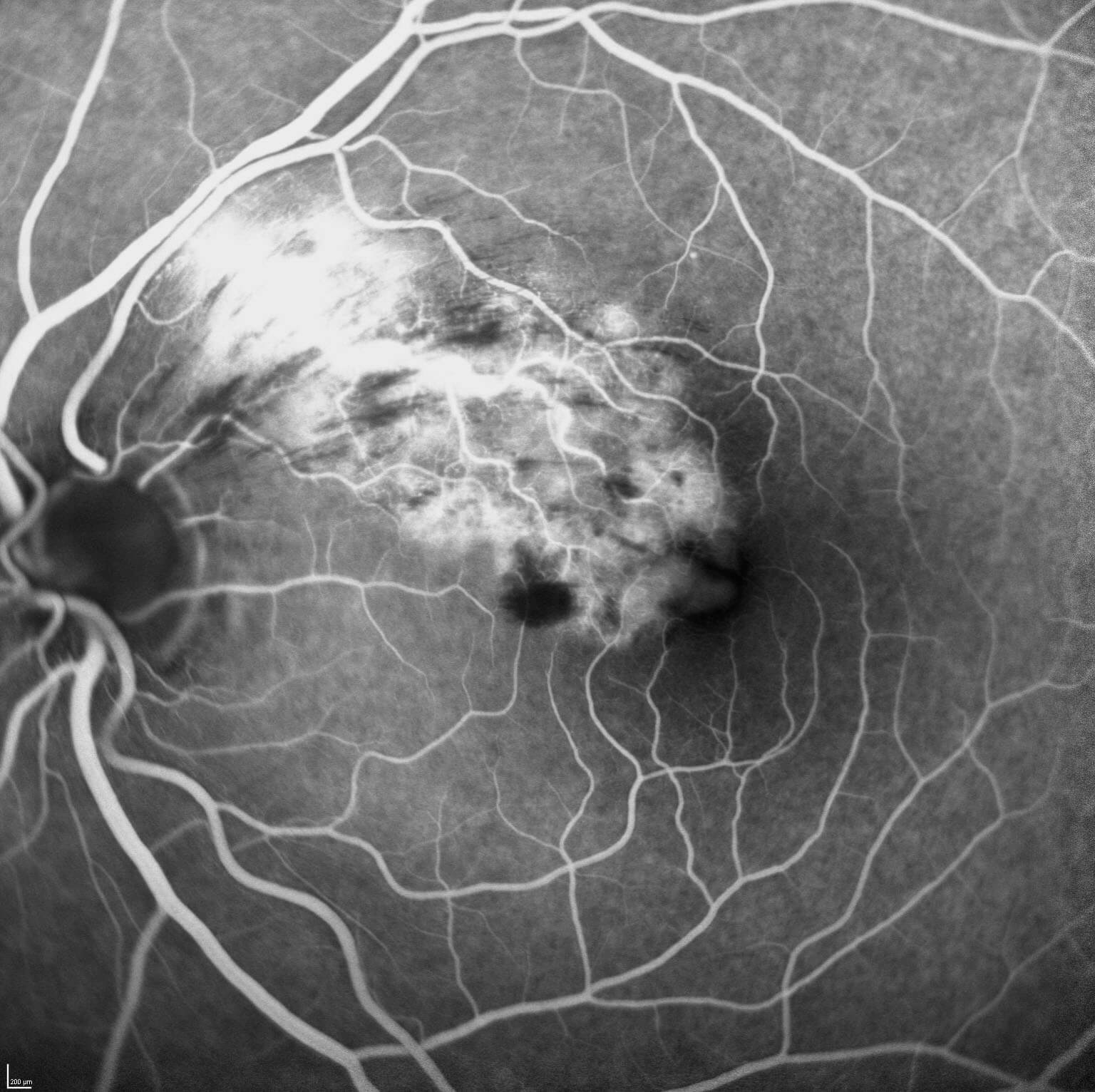 Late phase FFA of the left eye demonstrates leak and angiographic cystoid macular oedema.