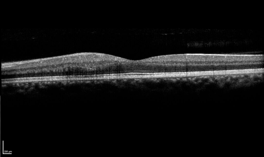 Late phase FFA of the left eye demonstrates leak and angiographic cystoid macular oedema.