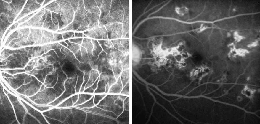Fluorescein angiography of the left macula demonstrates early hypofluorescent and late hyperfluorescent lesions.