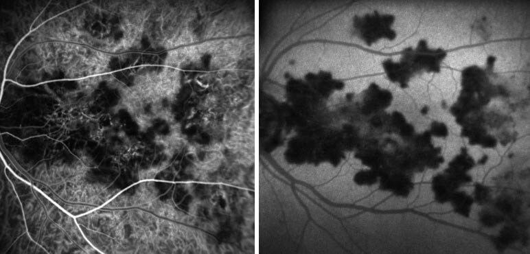 Indocyanine green angiography of the left macula demonstrates hypocyanescent lesions.
