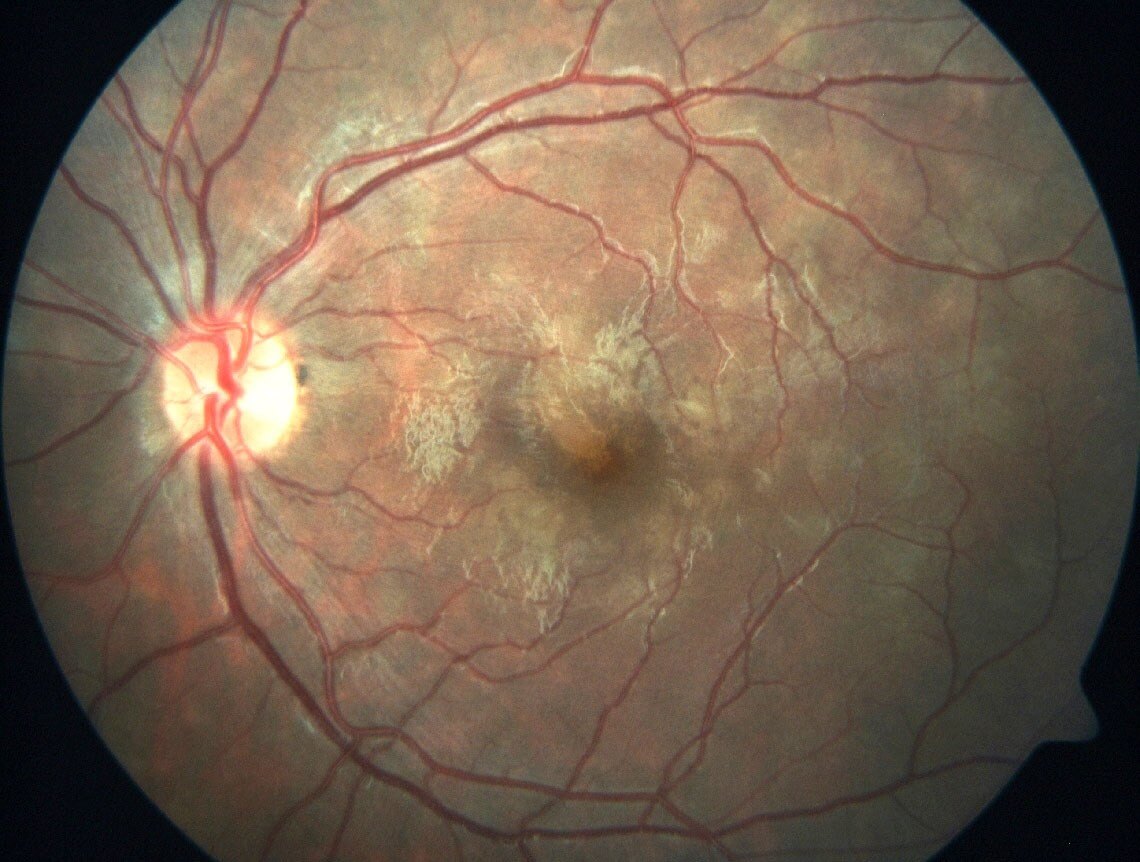 Deep yellow-white placoid lesions characteristic of APMPPE.