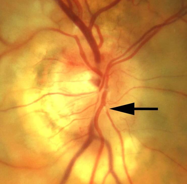 Magnified view of the right optic disc shows an embolus at the bifurcation of the inferior retinal arteriole.