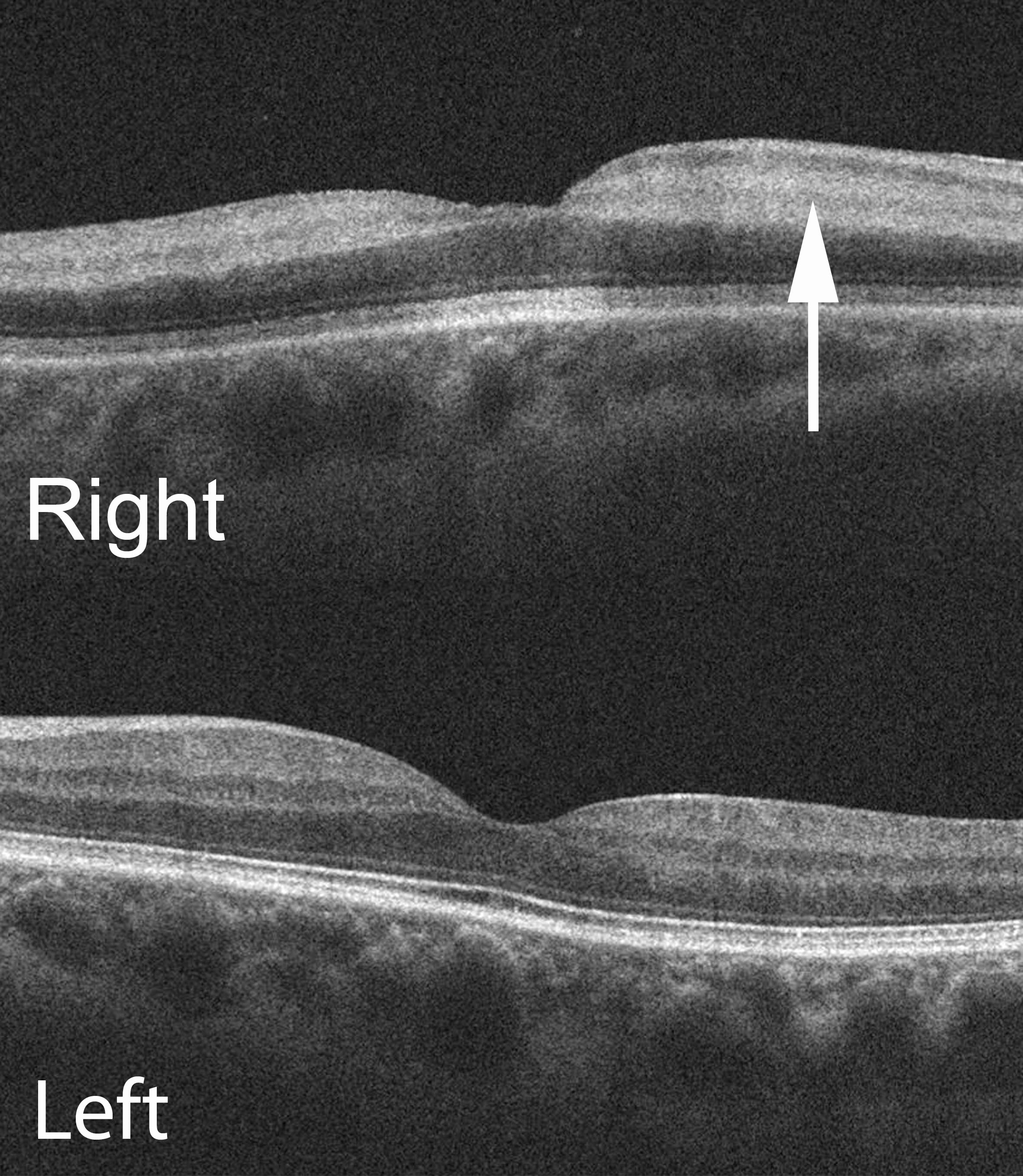 Right and Left optical coherence tomography (horizontal raster scans) through the macula demonstrate high reflectivity localized to the inner retina in the right eye.