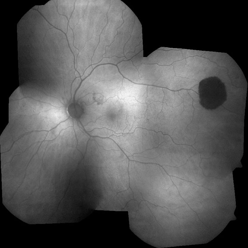 Fundus autofluorescence shows the lesion to be homogenously jet-black hypoautofluorescent.