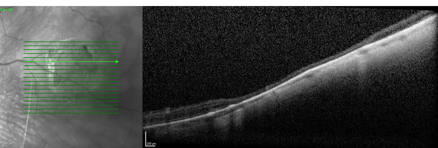 Spectral-domain optical coherence tomography demonstrates mild thickening of the retinal pigment epithelium with loss of the overlying outer retina.