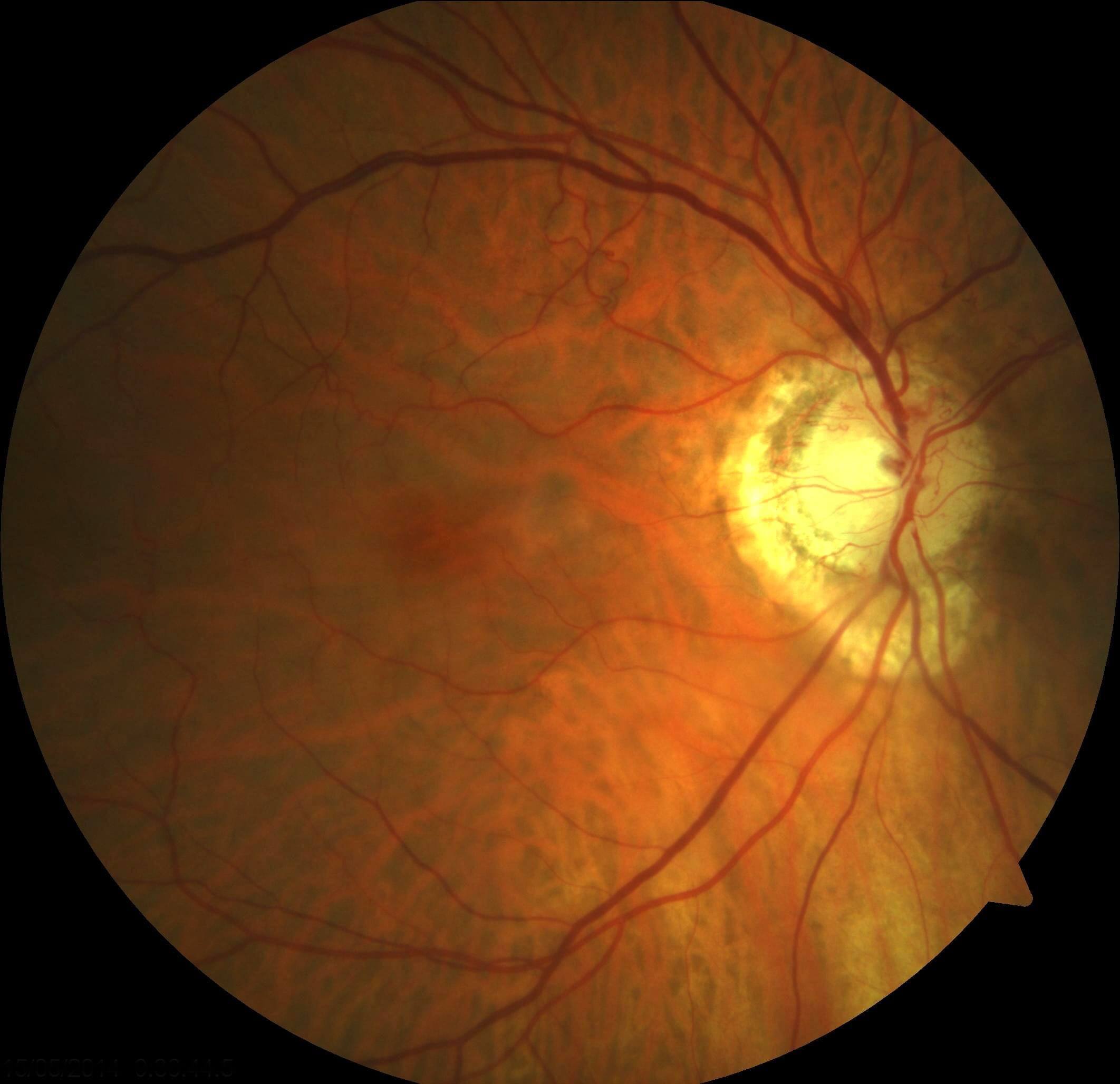 Three weeks after initial presentation there has been resolution of the retinal pallor and cherry red spot. The retinal emboli is still present, and the optic nerve is becoming pale (compared with Figure 1). Cilioretinal collateral vessels are present at the disc.
