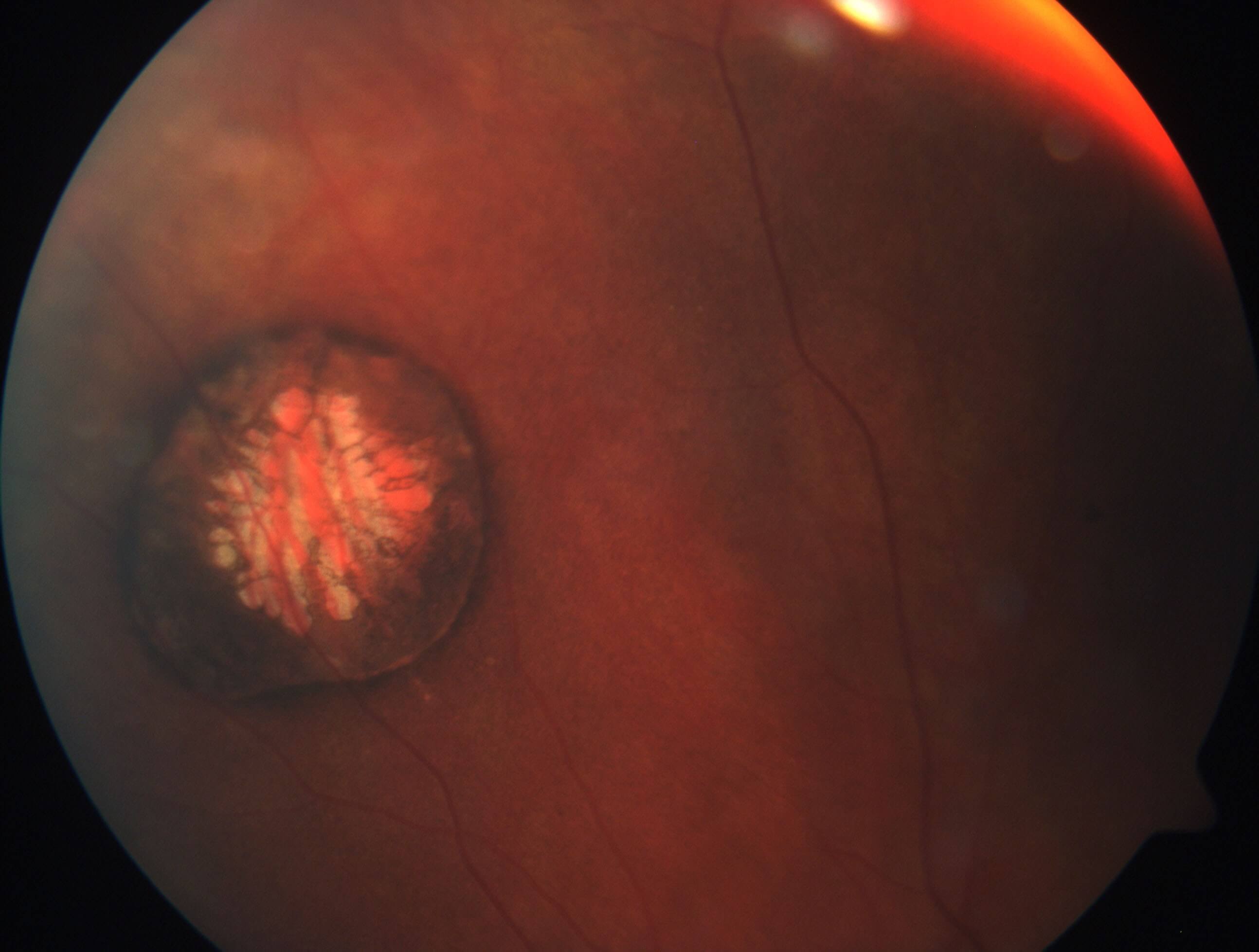 Colour fundus photograph of a congenital hypertrophy of the retinal pigment epithelium lesion with central pale lacunae where the retinal pigment epithelium is absent.