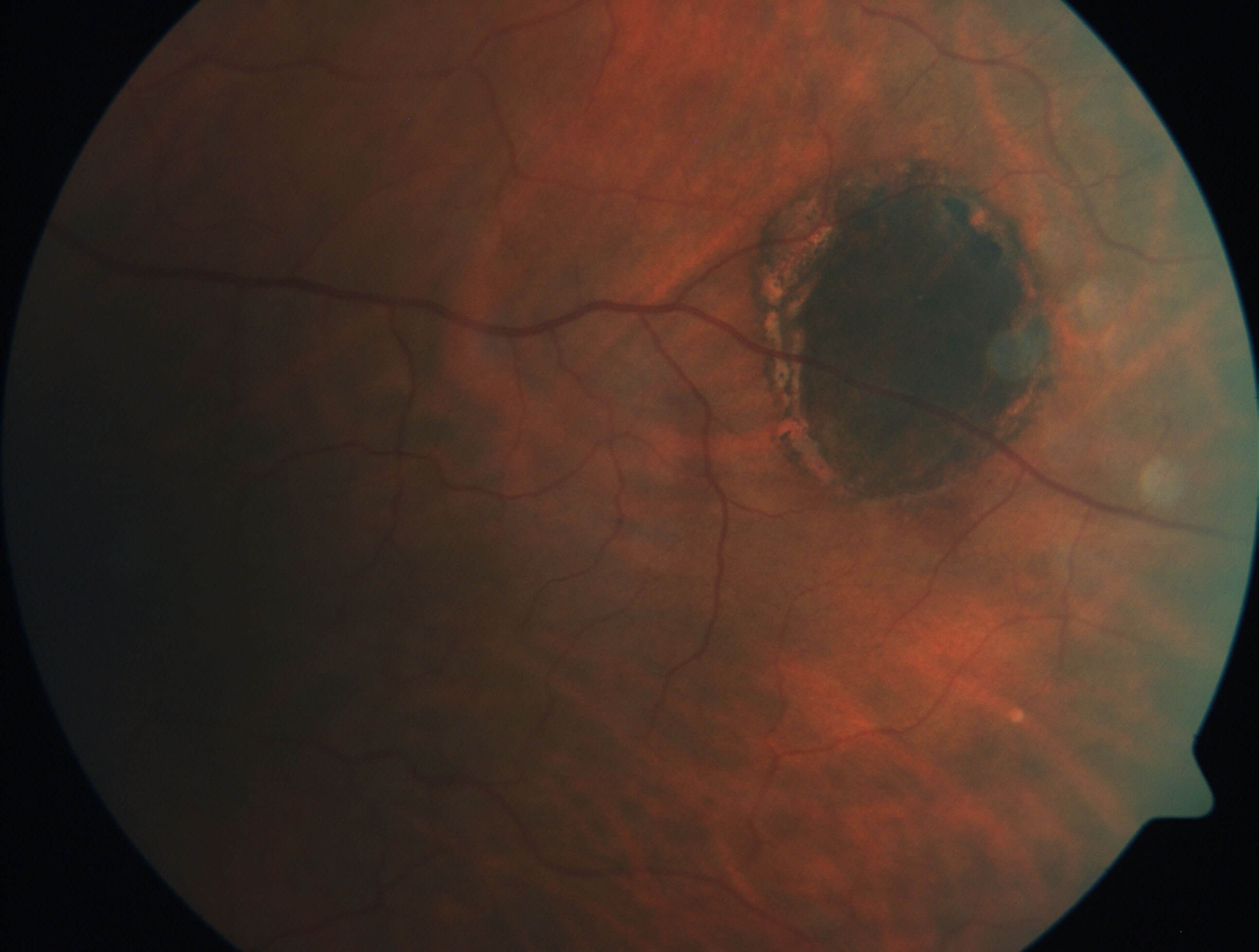 Magnified view of the left temporal pigmented lesion.