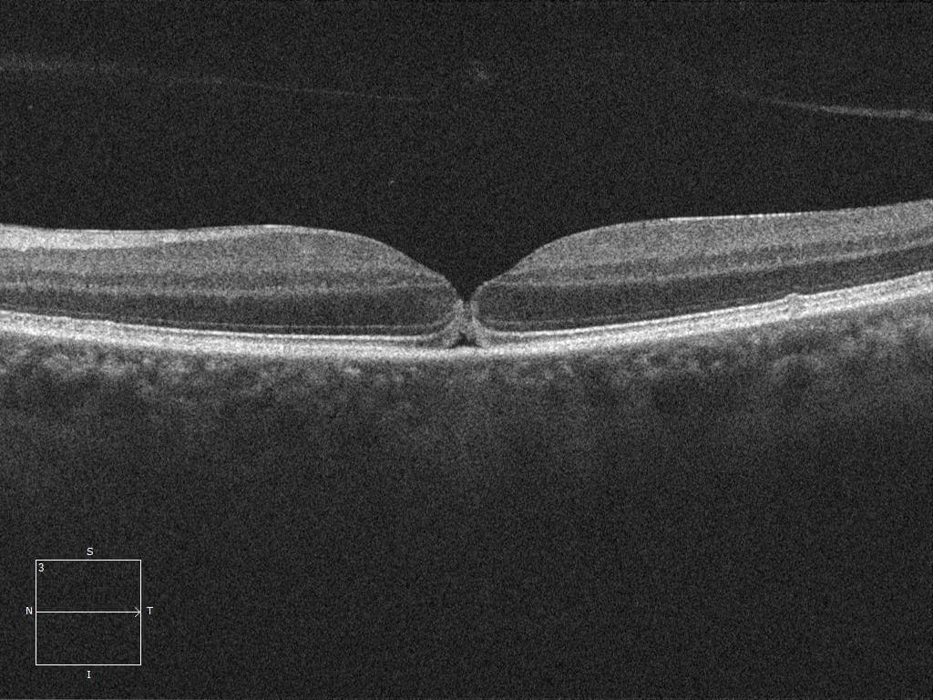 Left optical coherence tomography demonstrates a full thickness retinal disruption at the fovea. Note the rounded edges and overlying operculum. The posterior hyaloid has detached off the macula.