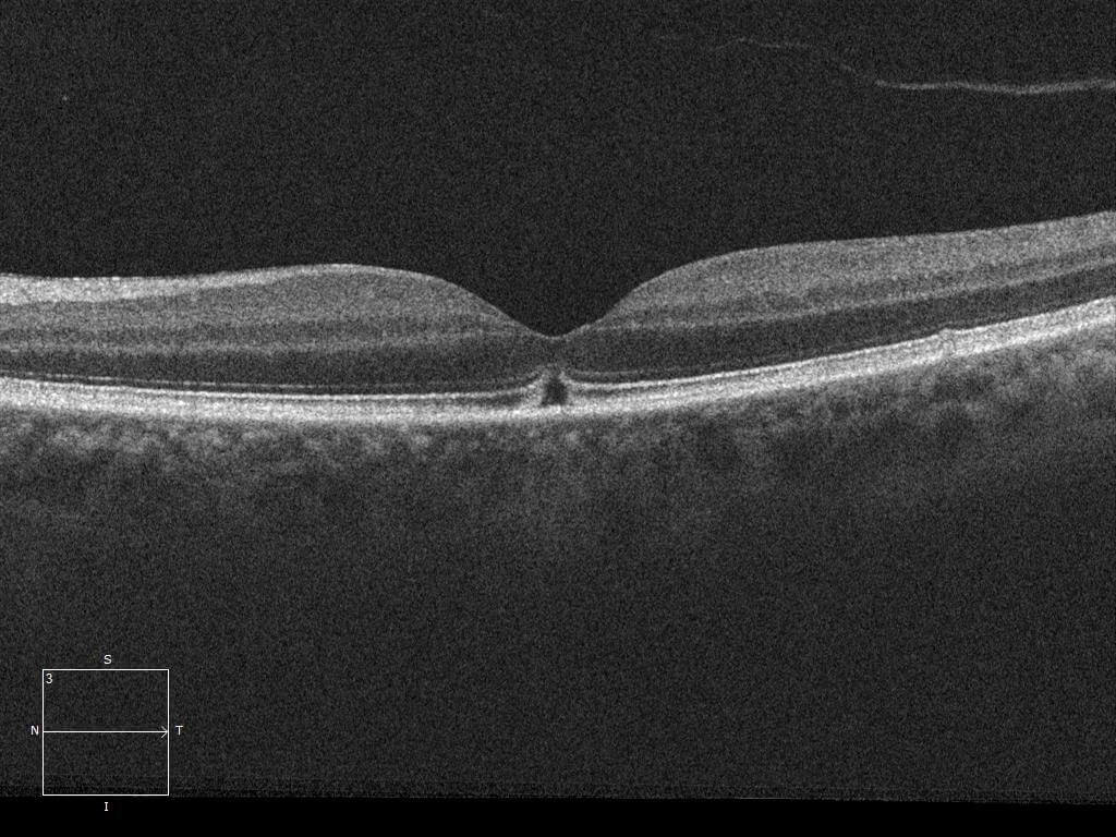 Left optical coherence tomography at 2 weeks. Note the continuity of the foveal contour and ‘bridging’ of the inner retina with persistent disruption of the outer retinal layers.