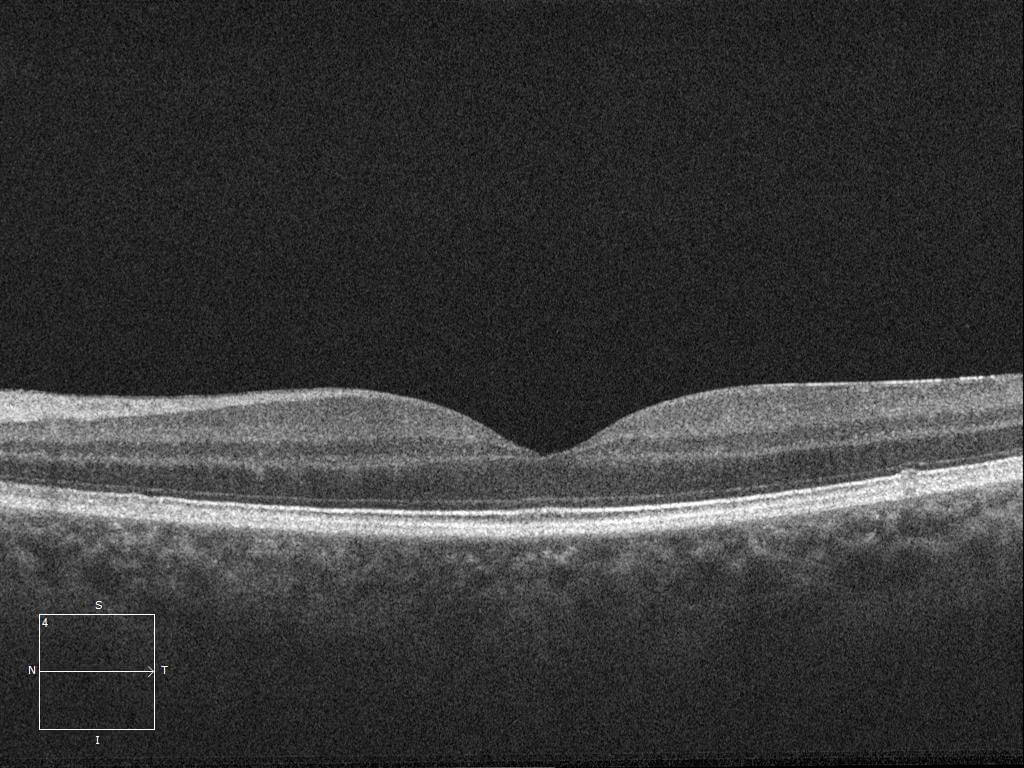 Left optical coherence tomography at 6 weeks. Note the restoration of the outer retina including the external limiting membrane and photoreceptors.