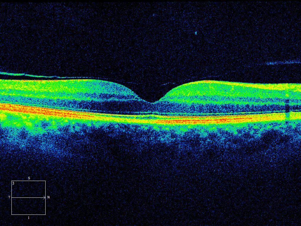 Right optical coherence tomography demonstrating separation of the vitreous from the fovea.