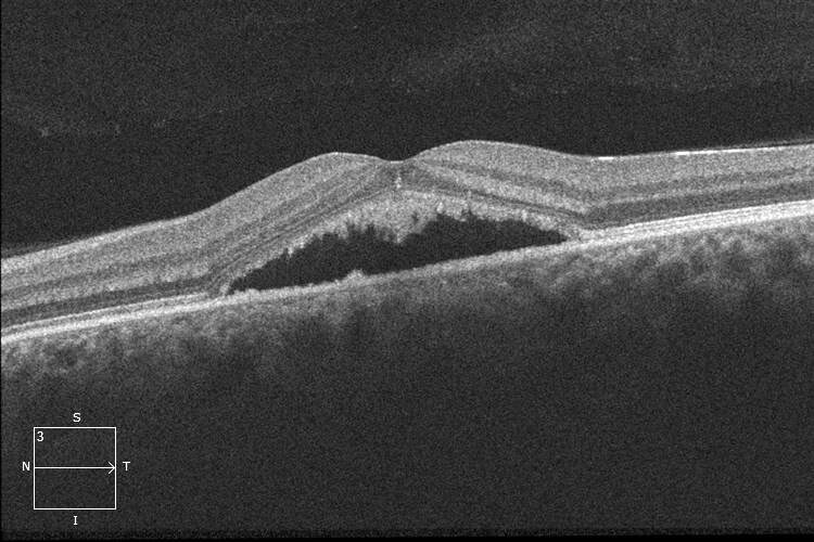 Left optical coherence tomography demonstrates a full thickness retinal disruption at the fovea. Note the rounded edges and overlying operculum. The posterior hyaloid has detached off the macula.