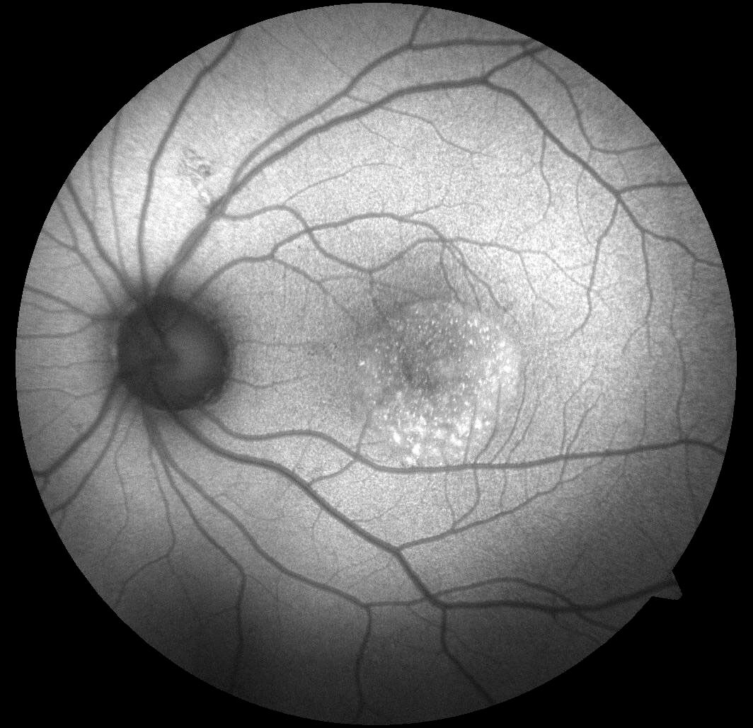 Left fundus autofluorescence image demonstrating multiple hyperautofluorescent dots within the serous retinal detachment.