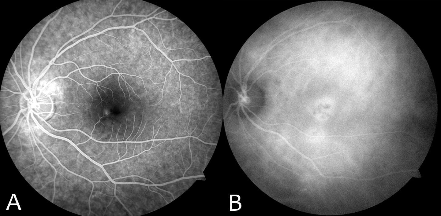 A) Fundus fluorescein angiography demonstrating focal leakage just inferonasal to the fovea. B) Midphase indocyanine green angiography (8 minutes) demonstrates choroidal hyperpermeability and hypercyanescence within the area of the serous detachment.