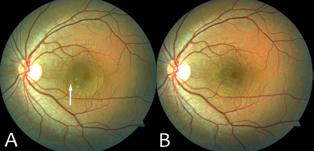 Left optical coherence tomography at 6 weeks. Note the restoration of the outer retina including the external limiting membrane and photoreceptors.
