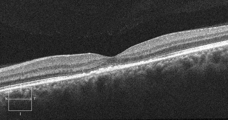Two-months following laser treatment the subretinal fluid has resolved leaving some residual retinal pigment epithelial changes.