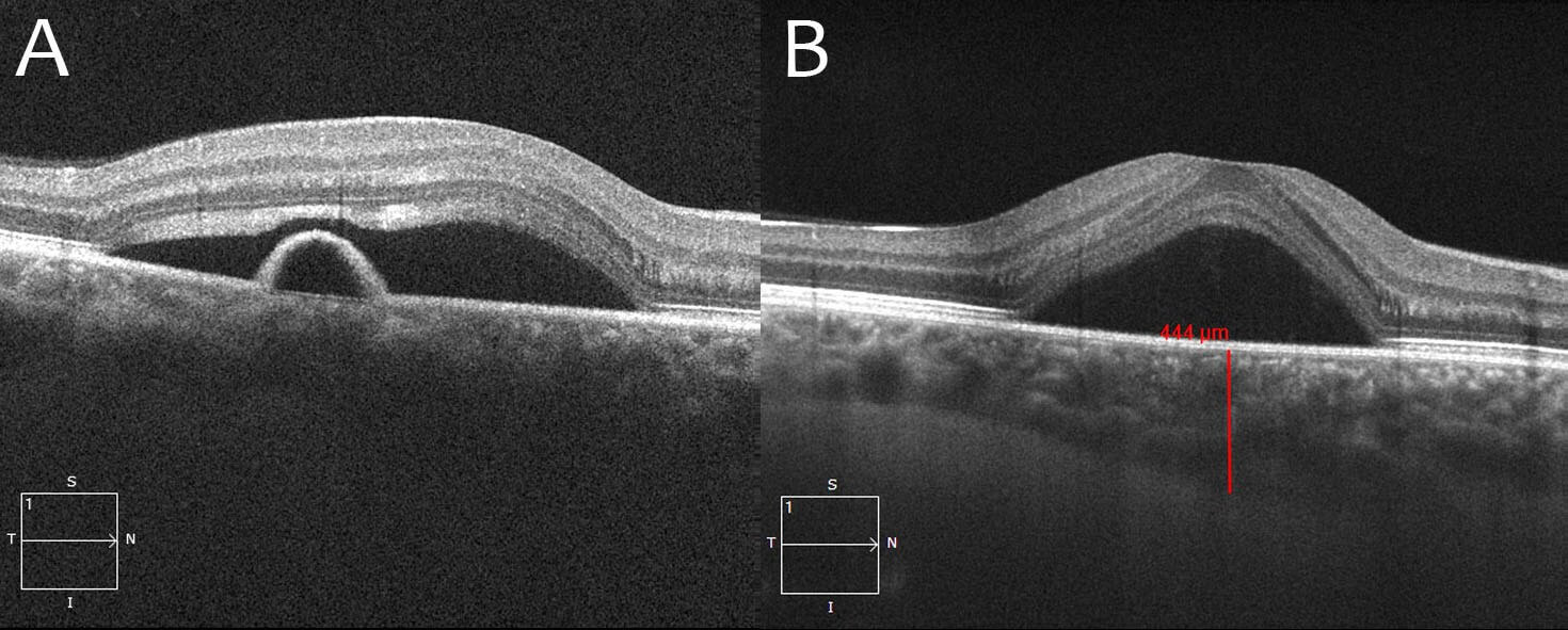 Two-months following laser treatment the subretinal fluid has resolved leaving some residual retinal pigment epithelial changes.