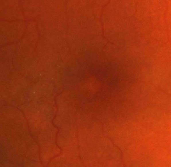 Magnified image of the right macula demonstrates the following changes temporal to the fovea: reduced retinal transparency, yellow crystals, intraretinal pigmentation and telangiectatic vessels with right angle venules.