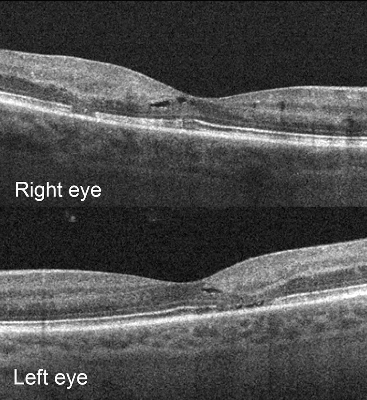  Horizontal optical coherence tomography (OCT) raster scans through the right and left maculae demonstrate hyporeflective inner retinal cavities and outer retinal loss temporal to the foveae.
