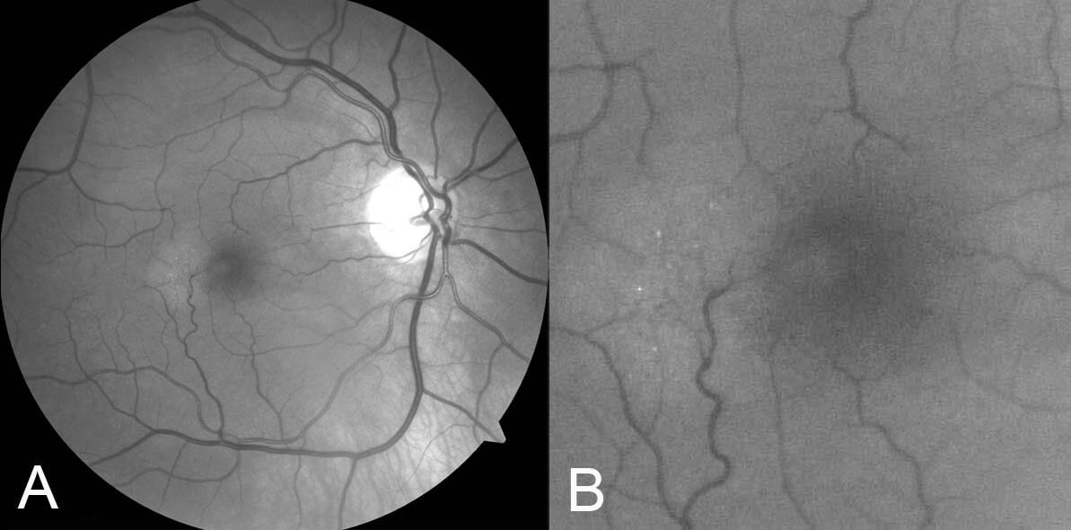  Red free photograph of the right macula (A and B, magnified view) reduced retinal transparency, crystals and telangiectatic vessels with right angle venules.