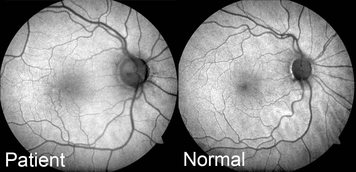 Fundus autofluorescence of the right macula in the affected patient (left) and a normal eye (right). In the affected patient there is reduced hypoautofluorescence that is usually seen at the fovea.