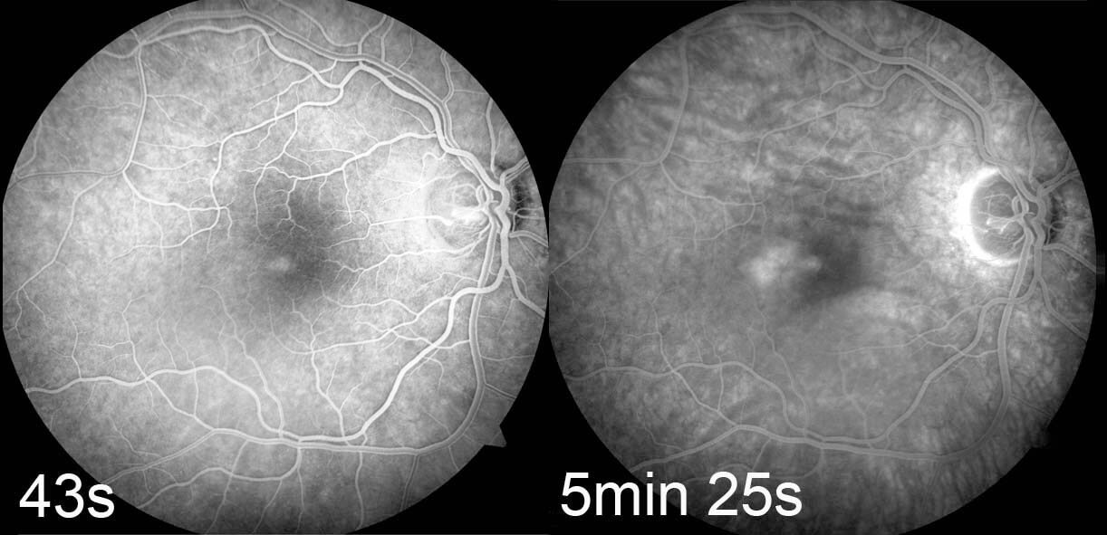 Fluorescein angiography shows increasing hyperfluorescence temporal to the right fovea.