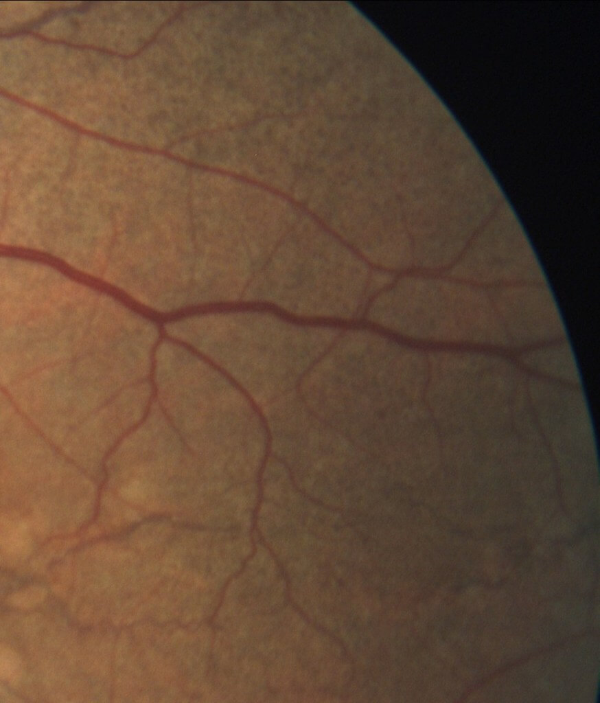 Magnified view of the left temporal fundus (rectangle from Figure 1a) reveals “peau d’orange” (French, “orange peel skin”).