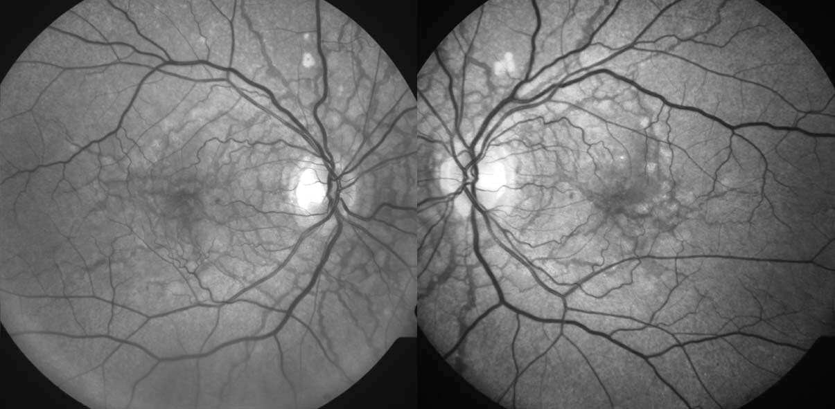 Red free fundus photography highlights the angioid streaks.