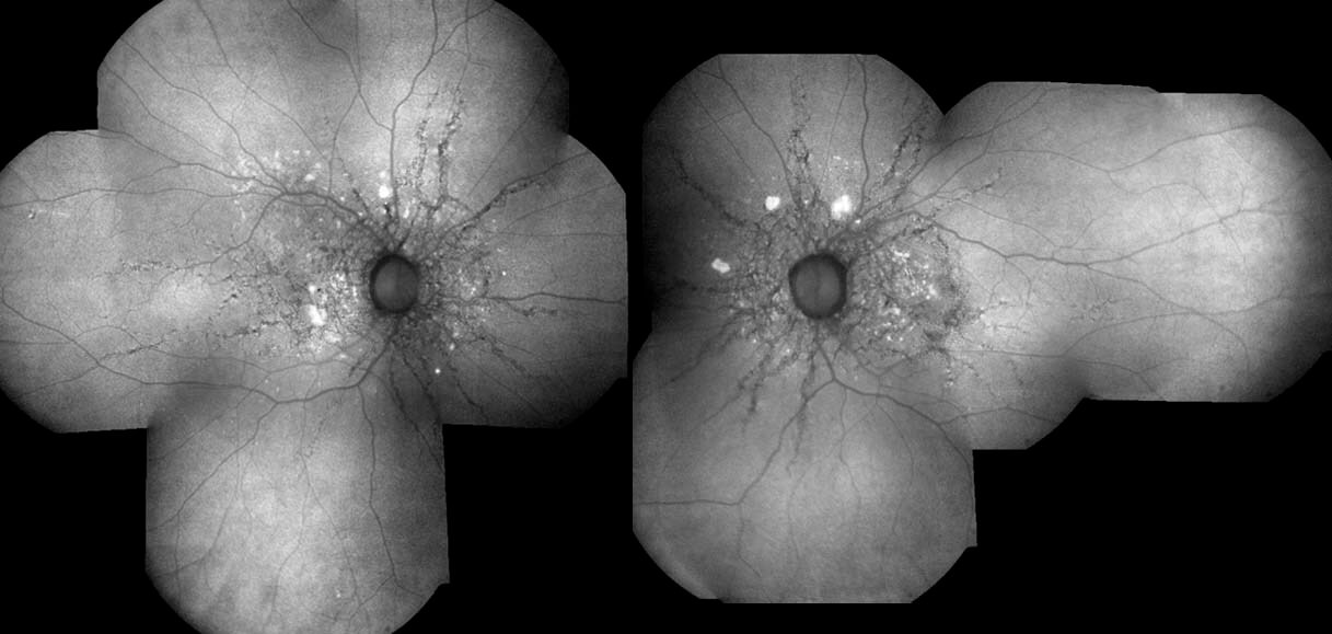 Fundus autofluorescence shows the angioid streaks as being hypoautofluorescent. In this patient there is no optic disc hyperautofluorescence, which can indicate the prescence of buried disc drusen.
