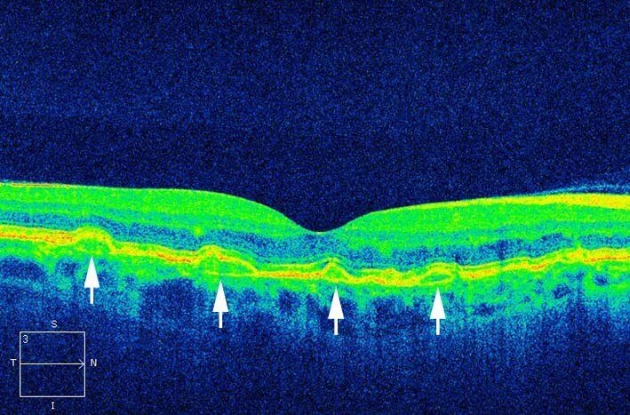 Optical coherence tomography shows the angioid streaks as disruptions in Bruch’s membrane with elevations of the retinal pigment epithelium.