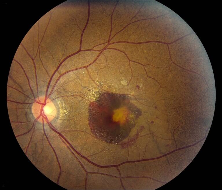 Fundus photograph of the left eye in a patient with angioid streaks secondary to pseudoxanthoma elasticum shows a submacular haemorrhage due to choroidal neovascularisation. This is one of the more common causes for vision in loss in patients with angioid streaks.