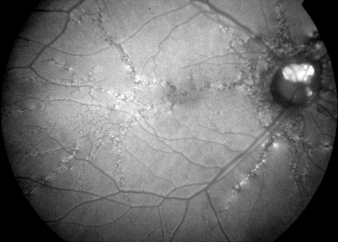 Fundus autofluorescence in a patient with pseudoxanthoma elasticum. The streaks are hypoautofluorescent with hyperautofluorescent stippling. Hyperautofluorescent buried optic disc drusen is present.