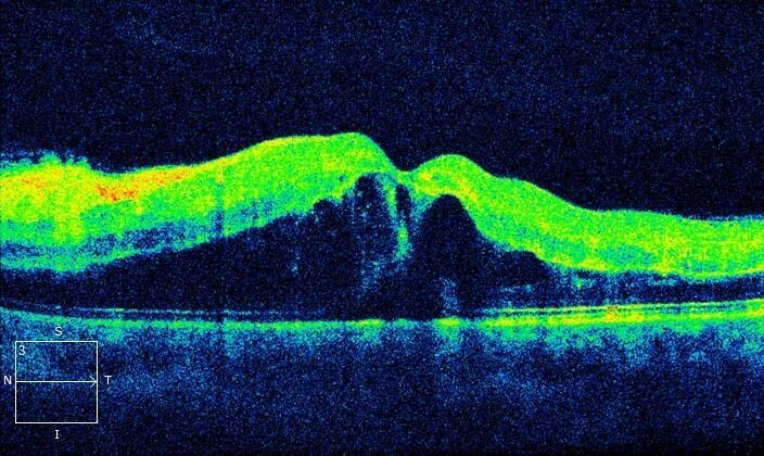 Left optical coherence tomography (horizontal raster scan) through the macula at presentation. There is gross cystoid macula oedema.