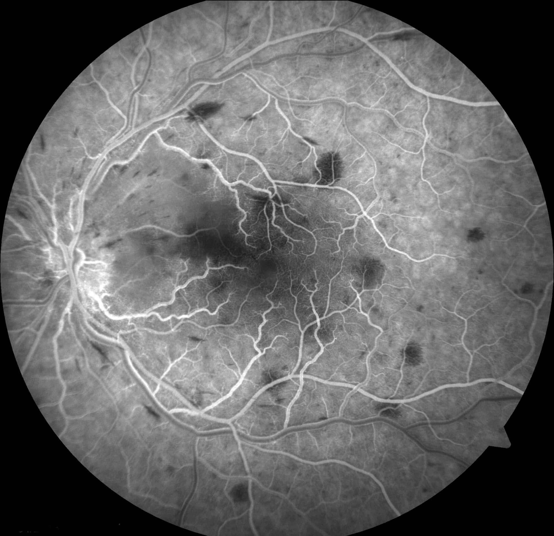 Red free fundus photography highlights the angioid streaks.