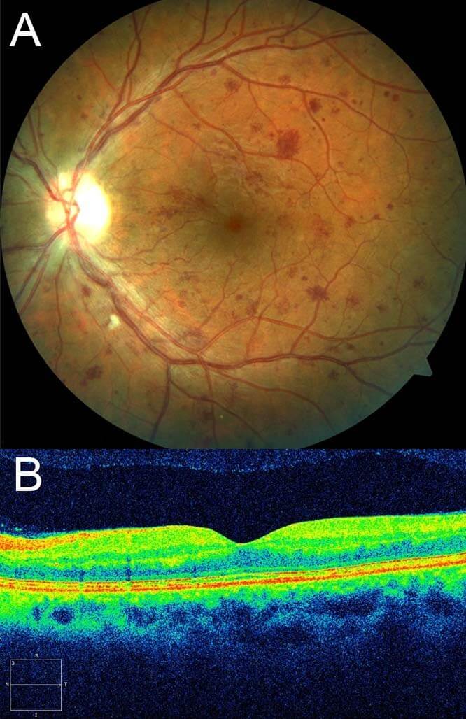 Fundus photograph of the left eye in a patient with angioid streaks secondary to pseudoxanthoma elasticum shows a submacular haemorrhage due to choroidal neovascularisation. This is one of the more common causes for vision in loss in patients with angioid streaks.