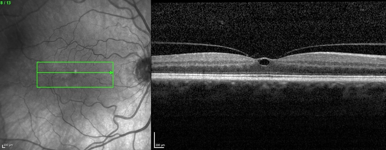 Left optical coherence tomography (horizontal raster scan) through the macula at presentation. There is gross cystoid macula oedema.