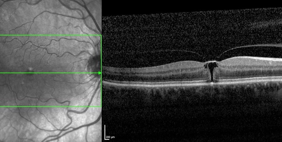 Right optical coherence tomography (horizontal raster scan) through the macula three months after initial presentation. There is a small full thickness macula hole.