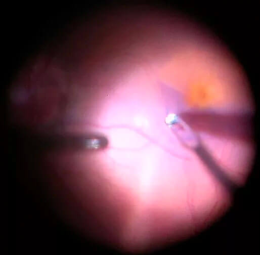 Right optical coherence tomography (horizontal raster scan) through the macula three months after initial presentation. There is a small full thickness macula hole.