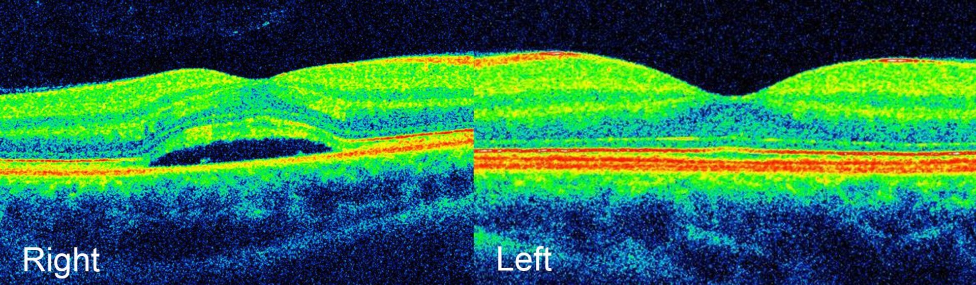 Right and left optical coherence tomography scans. There is subretinal fluid at the right macula.