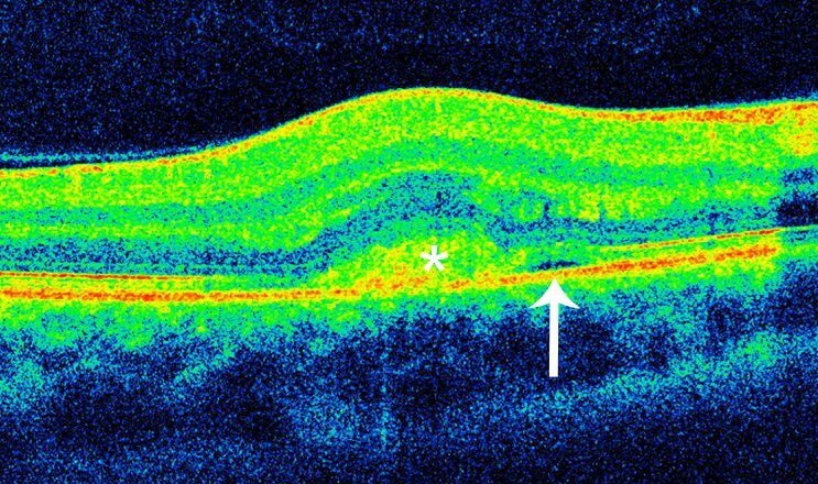 Scans through the region of the grey/green lesion demonstrates disturbance of the retinal pigment epithelial signal and a hyperreflective dome shaped lesion located beneath the retina with associated overlying retinal thickening. This represents the choroidal neovascular membrane. There is a trace amount of subretinal fluid.
