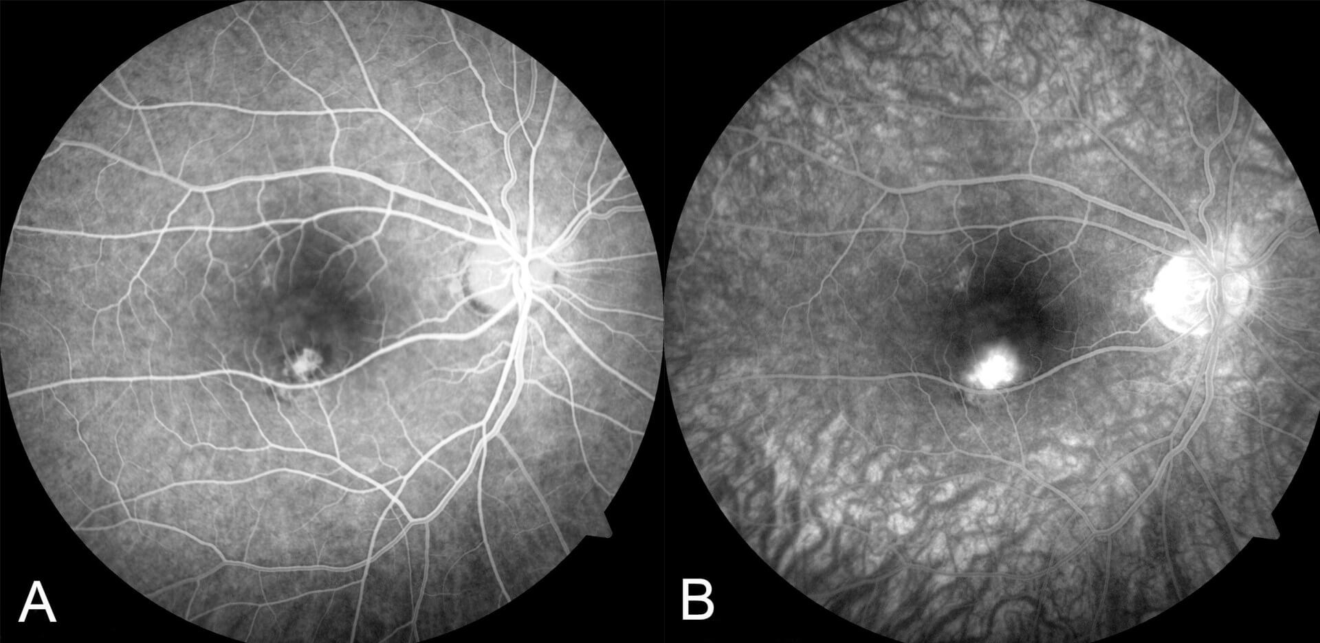 Scans through the region of the grey/green lesion demonstrates disturbance of the retinal pigment epithelial signal and a hyperreflective dome shaped lesion located beneath the retina with associated overlying retinal thickening. This represents the choroidal neovascular membrane. There is a trace amount of subretinal fluid.