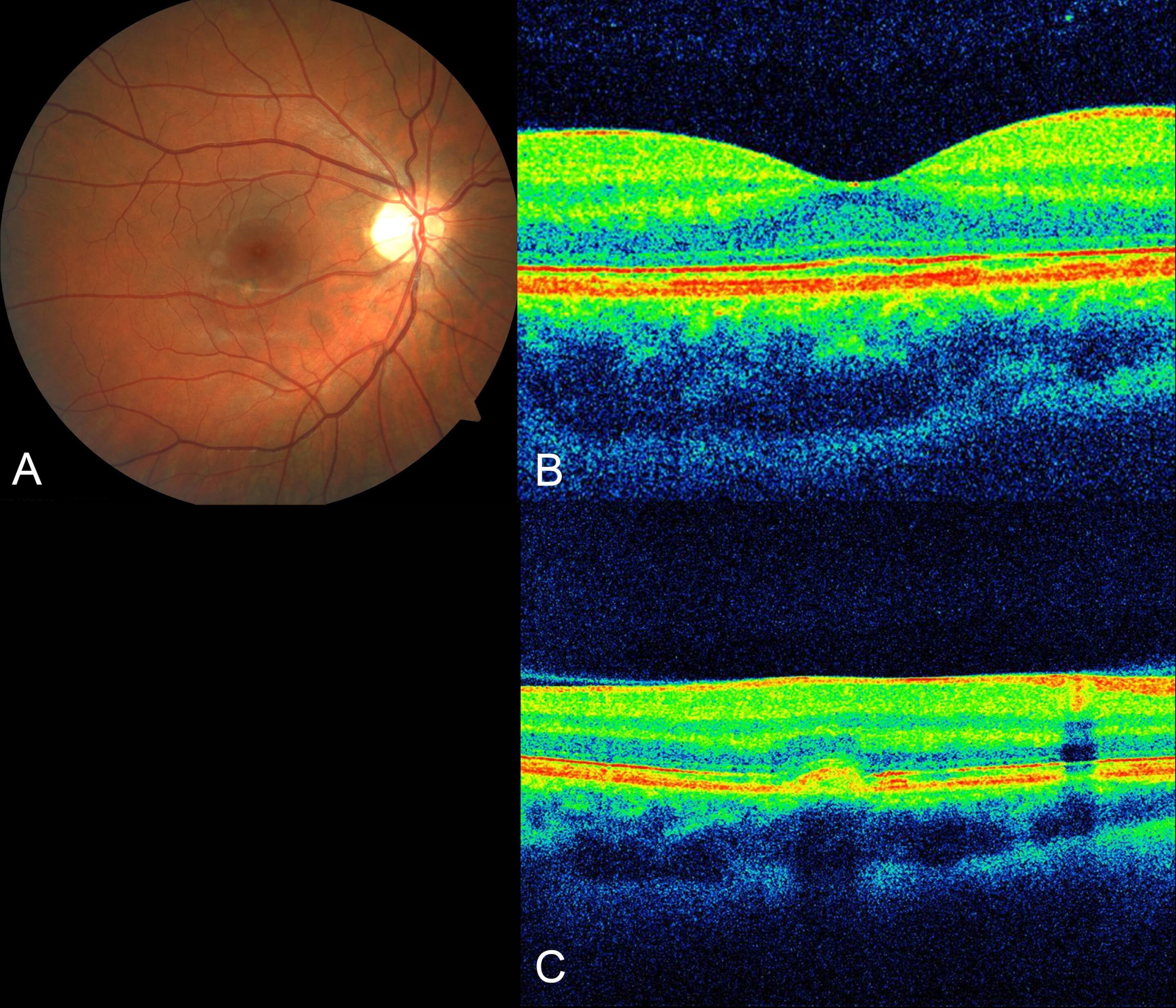 Right optical coherence tomography (horizontal raster scan) through the macula three months after initial presentation. There is a small full thickness macula hole.